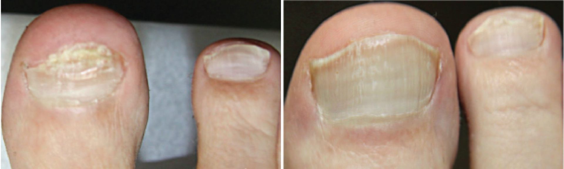 Toenail Fungus Laser Treatment Calgary, AB Derm.ca
