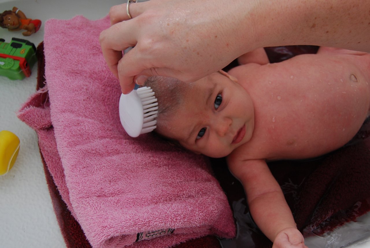 Cradle Cap