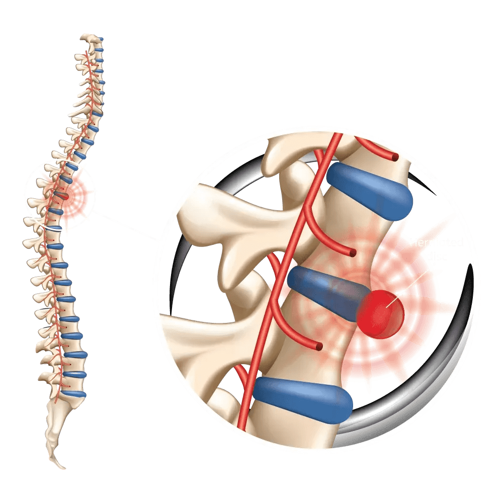 Spinal & Disc Therapy