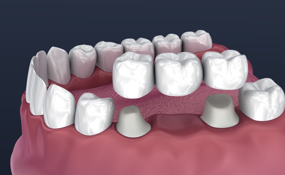 Partial Dentures Help Fill The Gaps Caused By Missing Teeth