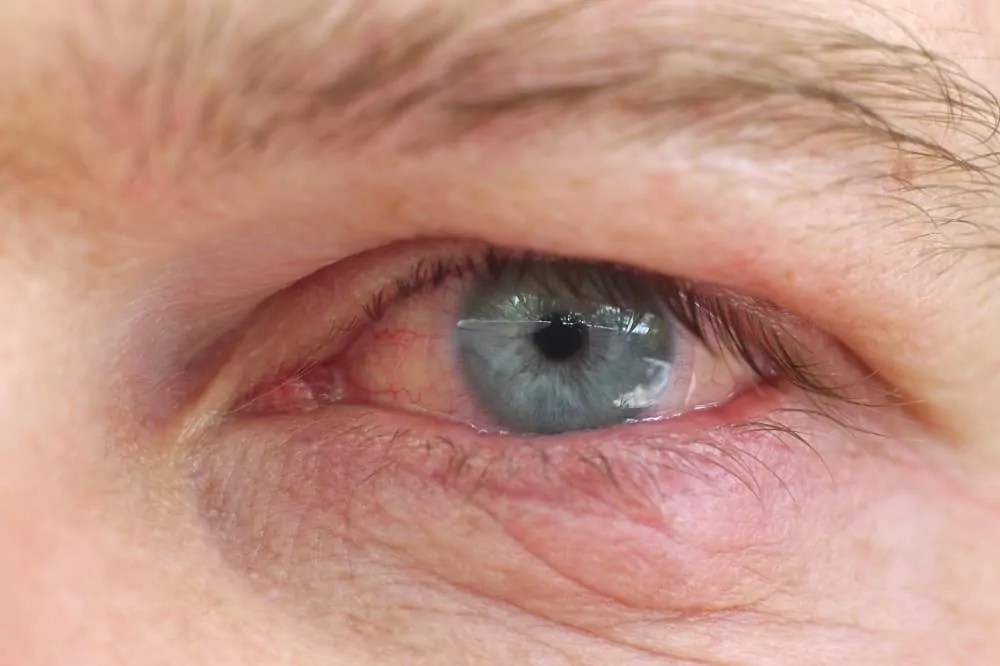 Red Eyes from Contact Lenses Causes and Solutions