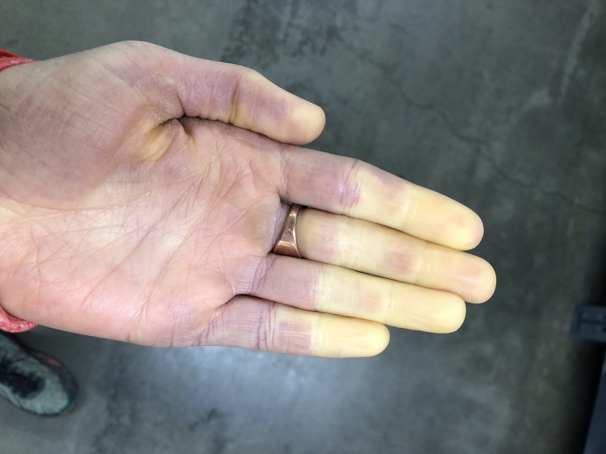 Managing Raynaud’s Phenomenon and Cold Extremities iRunFar