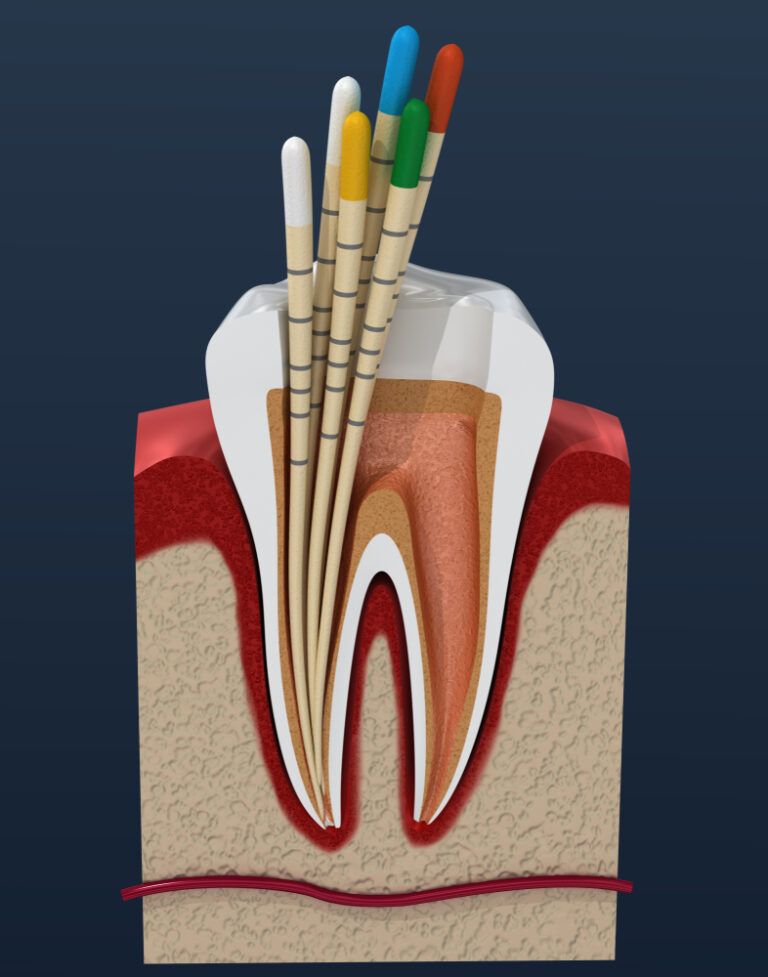 Root Canal Sealers Dr. Fay Mansouri