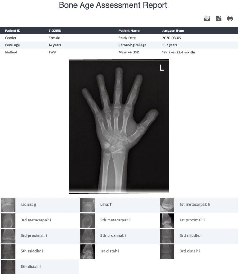 Evaluation of the clinical efficacy of a TW3based fully automated bone