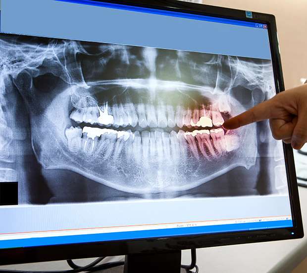 Digital XRays iSmile Dental Spa Carmichael California