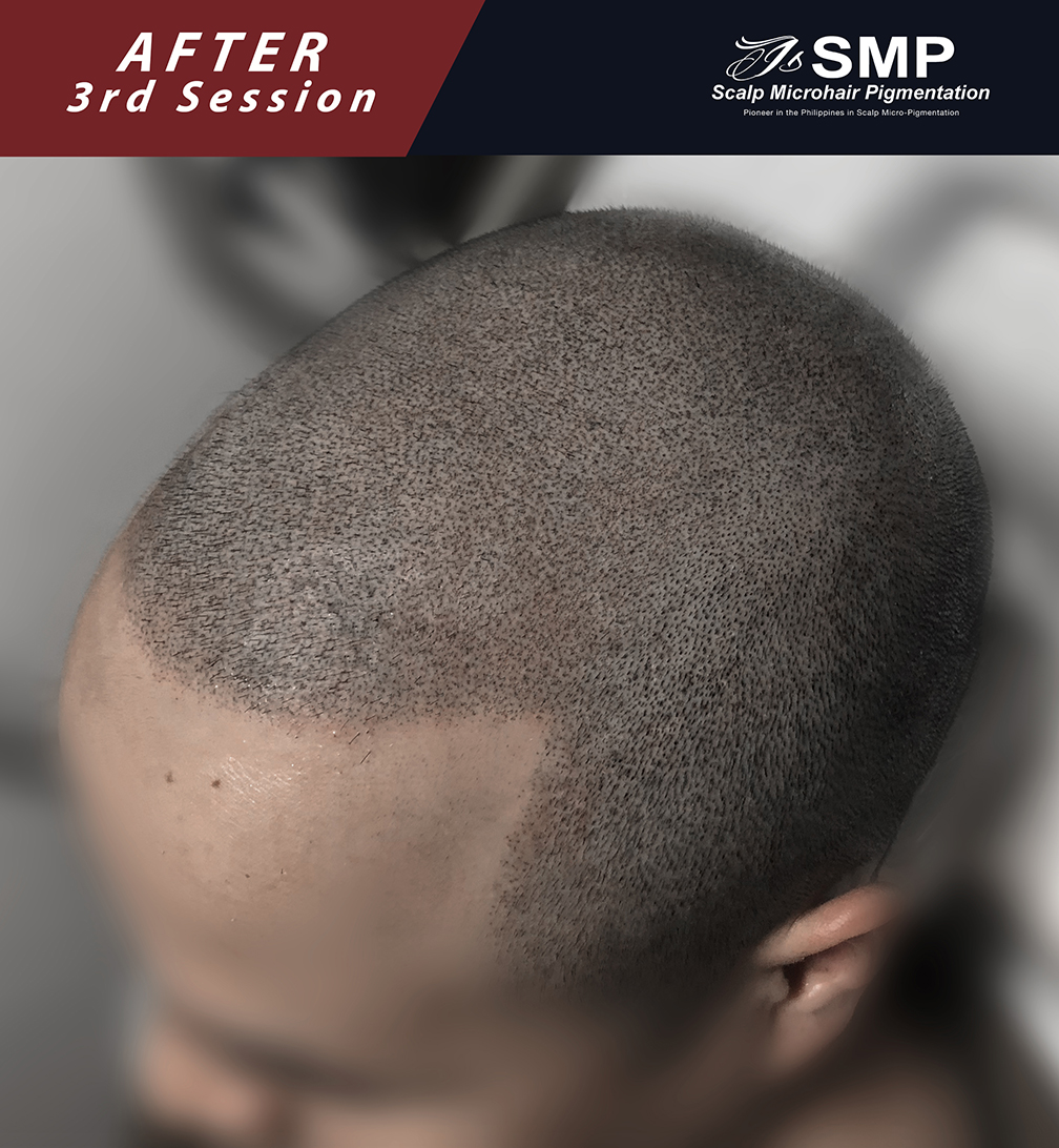 I S Smp Scalp Microhair Pigmentation Pioneer In The