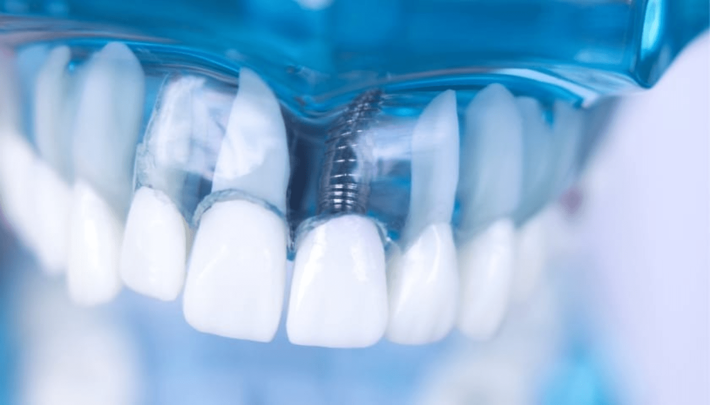 Operative instructions for dental IST Smile Experts