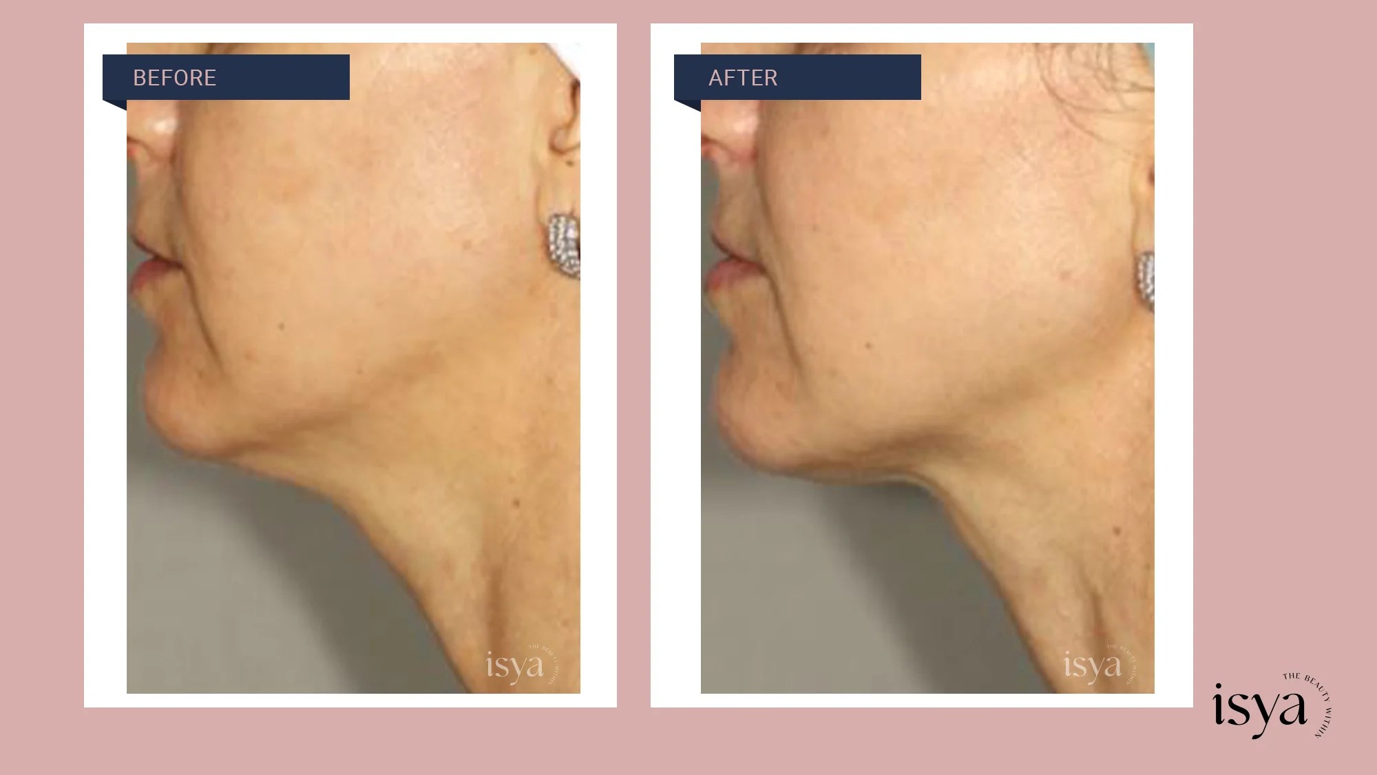 NonInvasive Face Lift in Vasant Vihar, New Delhi