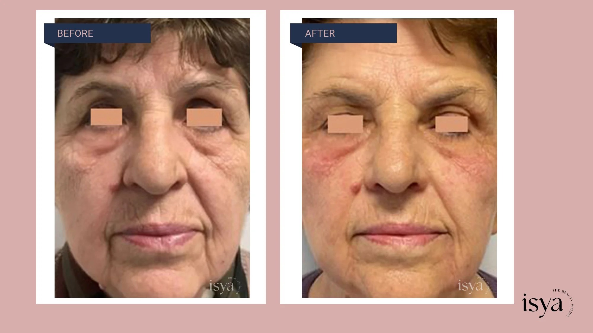 NonInvasive Face Lift in Vasant Vihar, New Delhi