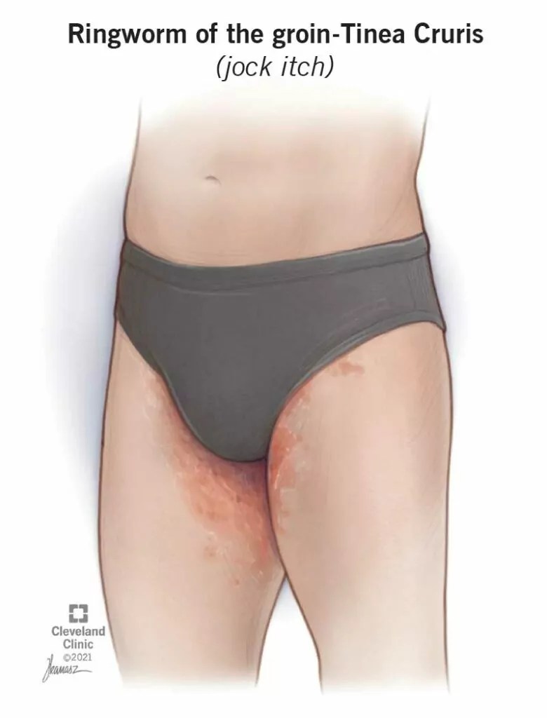 Jock Itch Cos'è, Sintomi E Trattamento SFOMC