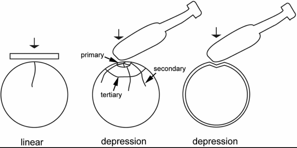 Blunt Force Trauma Definition, Symptoms & Examples It Lesson Education