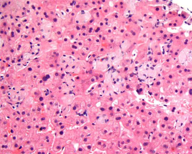 Gaucher Disease Symptoms, Causes, Treatment