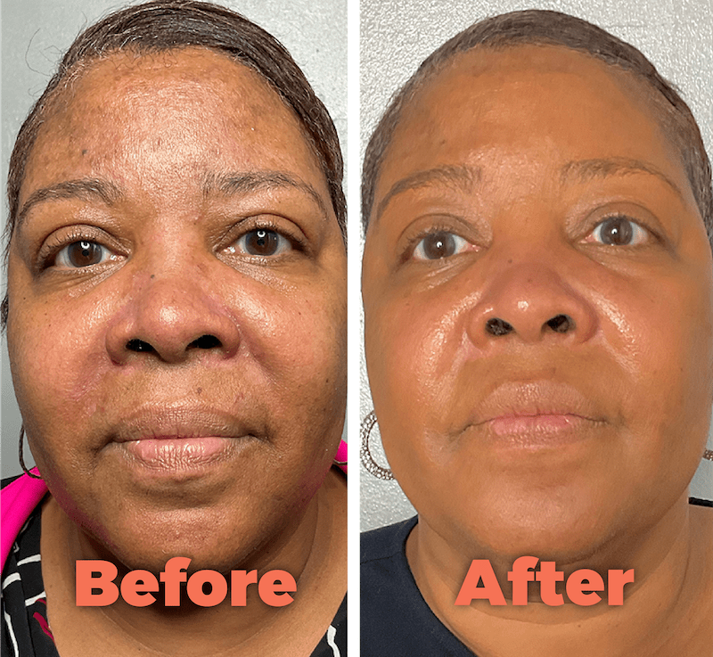 What's a Vi Peel? Your Questions Answered by a Professional The Sway