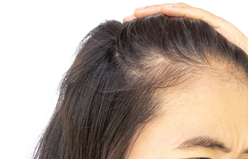 Does the IUD Cause Hair Loss? IUD Alert