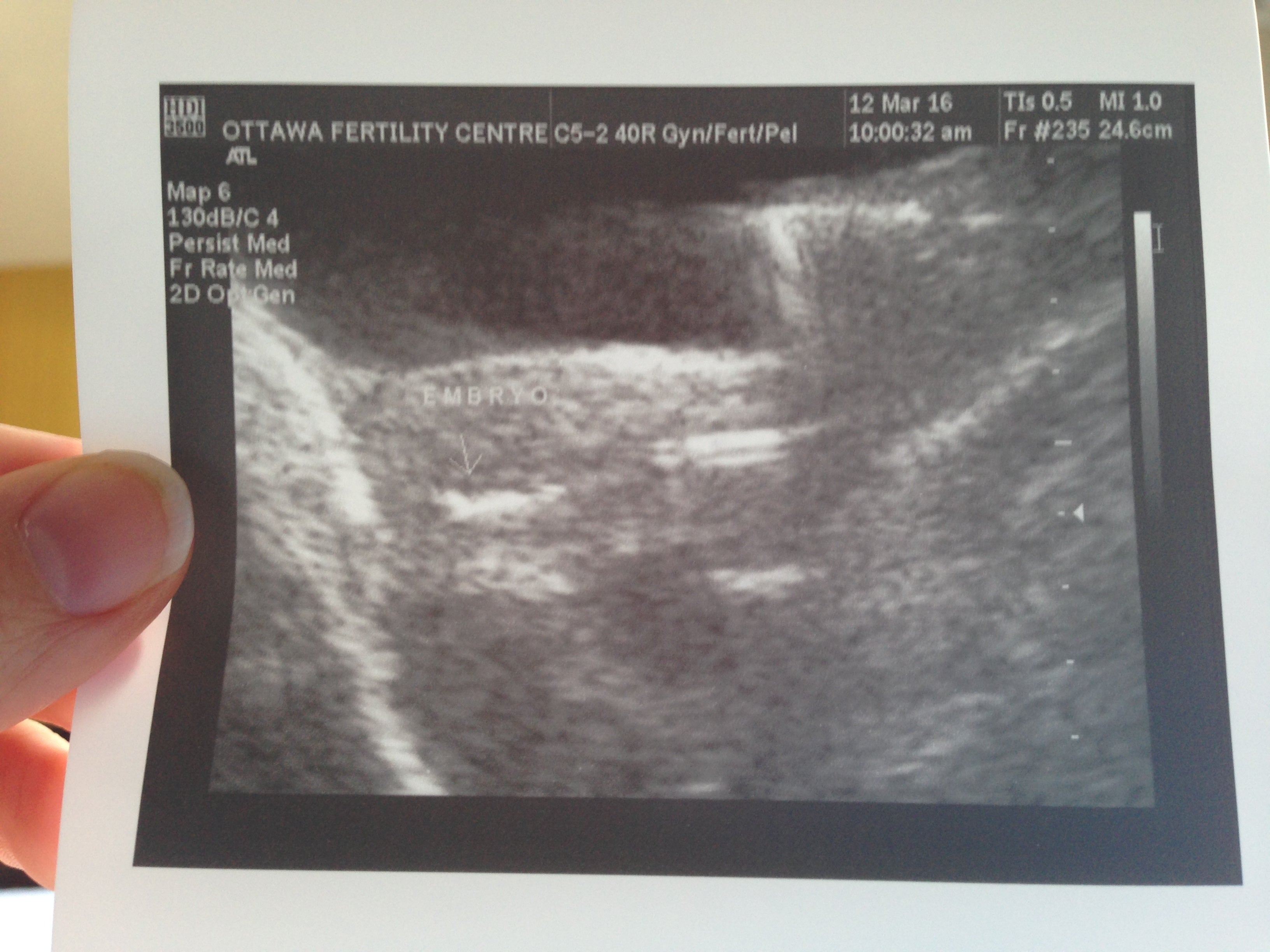 Catching up to where I am now. IVF.ca Forums