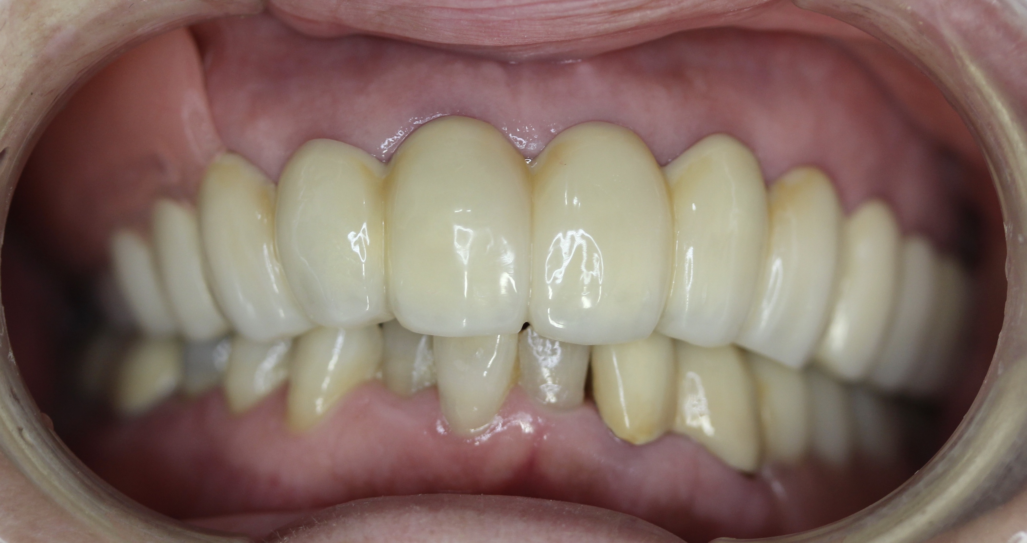 40代・50代の人におすすめの、目立たない入れ歯はありますか？ 神奈川県茅ヶ崎、藤沢、平塚市の入れ歯なら岩田歯科医院へ