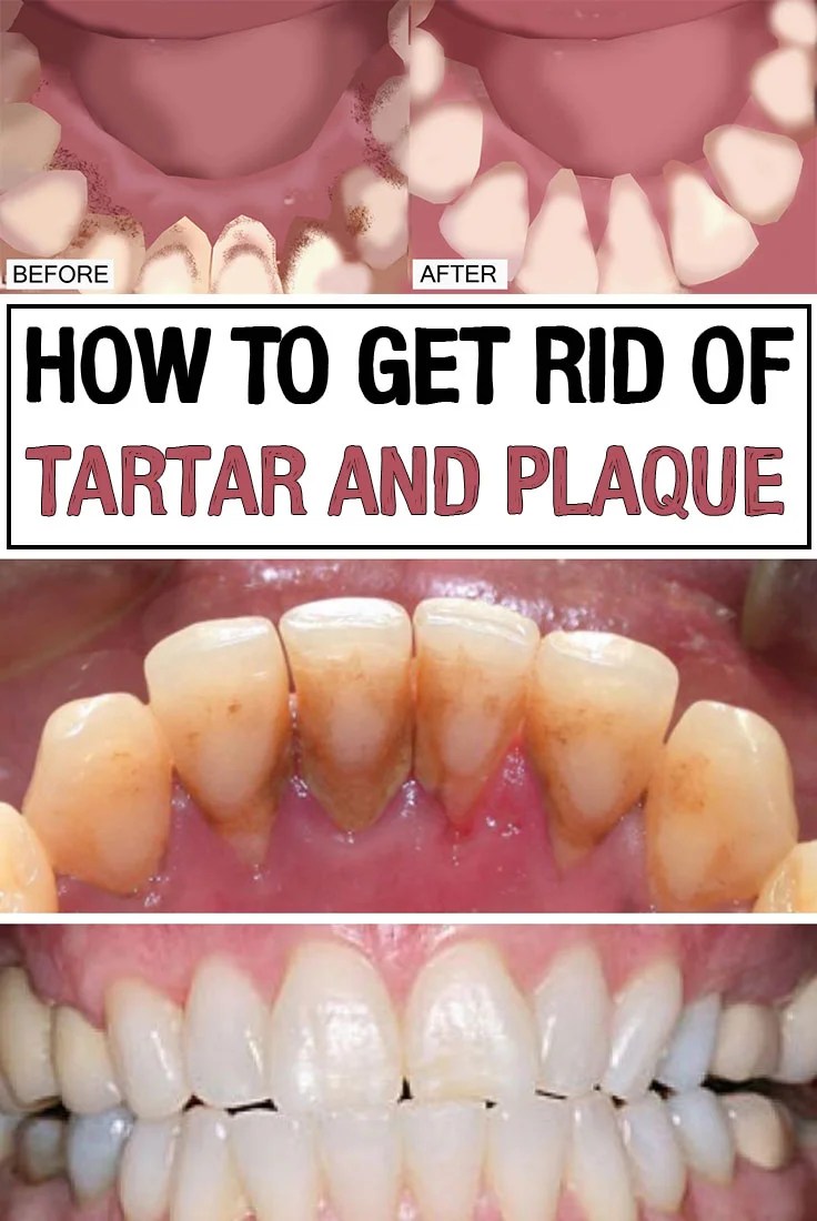How to get rid of tartar and plaque iwomenhacks