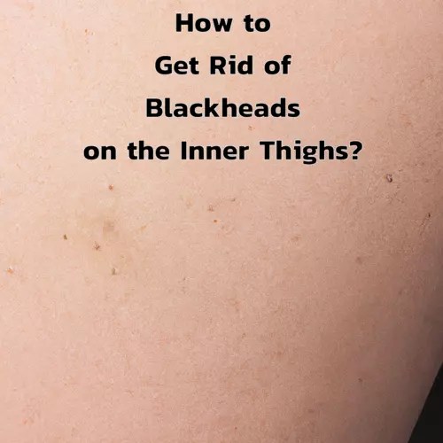 Blackheads on the Inner Thighs How to Get Rid of Them?