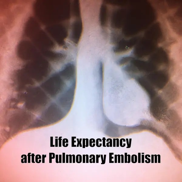 Life Expectancy after Pulmonary Embolism Health Advisor
