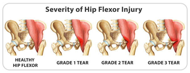 Hip Flexor Strain Signs, Causes, Treatment and Recovery