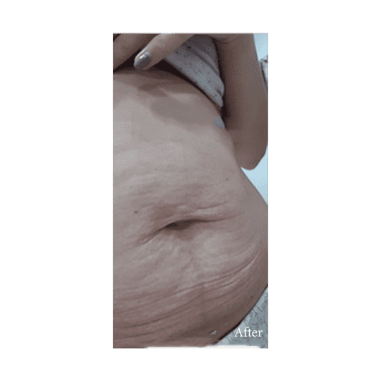 Body Contouring Jade Aestetic Clinic