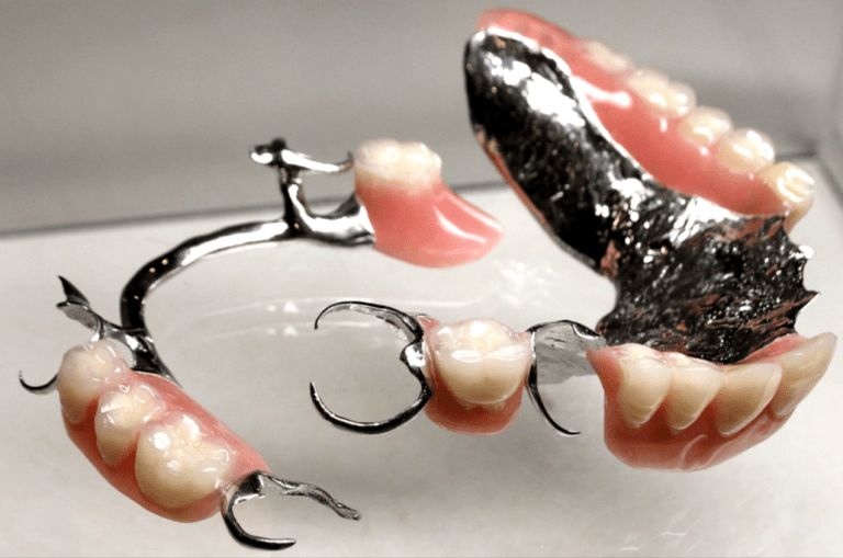 2. Metal Frame Partials JA Denture Clinic