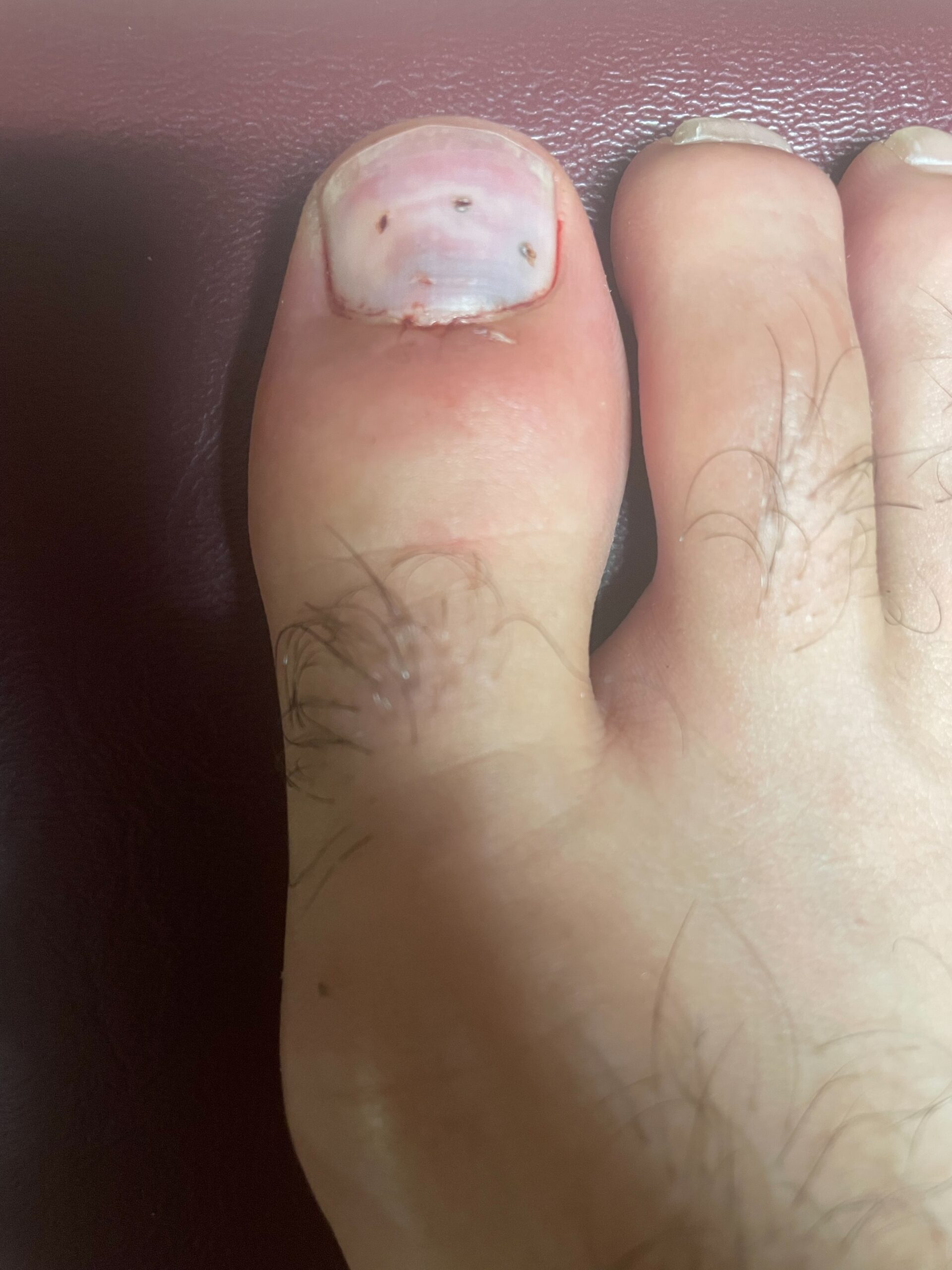 Blood Under the Toe Nail from Injury Urgent Care Walkin Medical Care