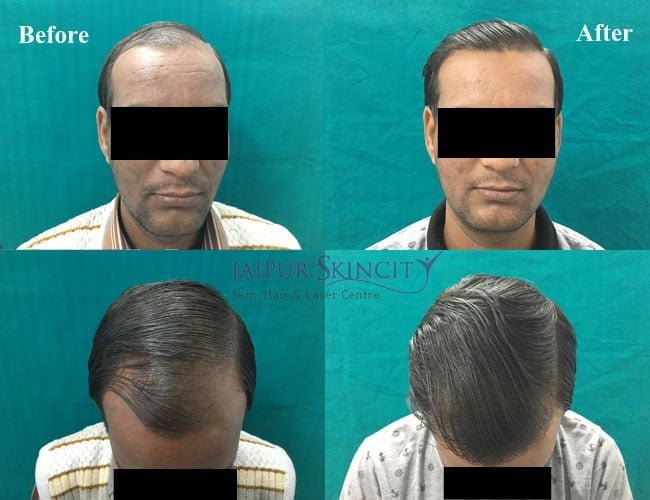 Best Hair Transplant In Jaipur Hair Treatment Jaipur Skincity