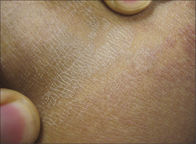 Evoked Scale Sign of Tinea Versicolor Dermatology JAMA Dermatology JAMA Network