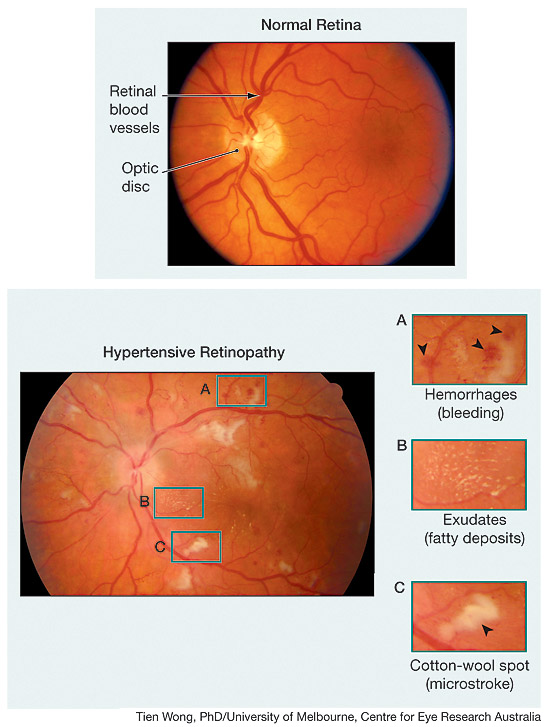 Retinopathy Ophthalmology JAMA The JAMA Network