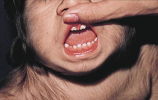 Primary Generalized and Localized Hypertrichosis in Children