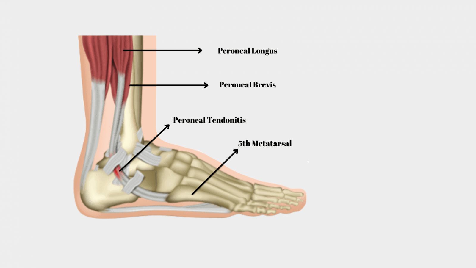 Peroneal Tendonitis Symptoms and treatment for Peroneal Tendonitis