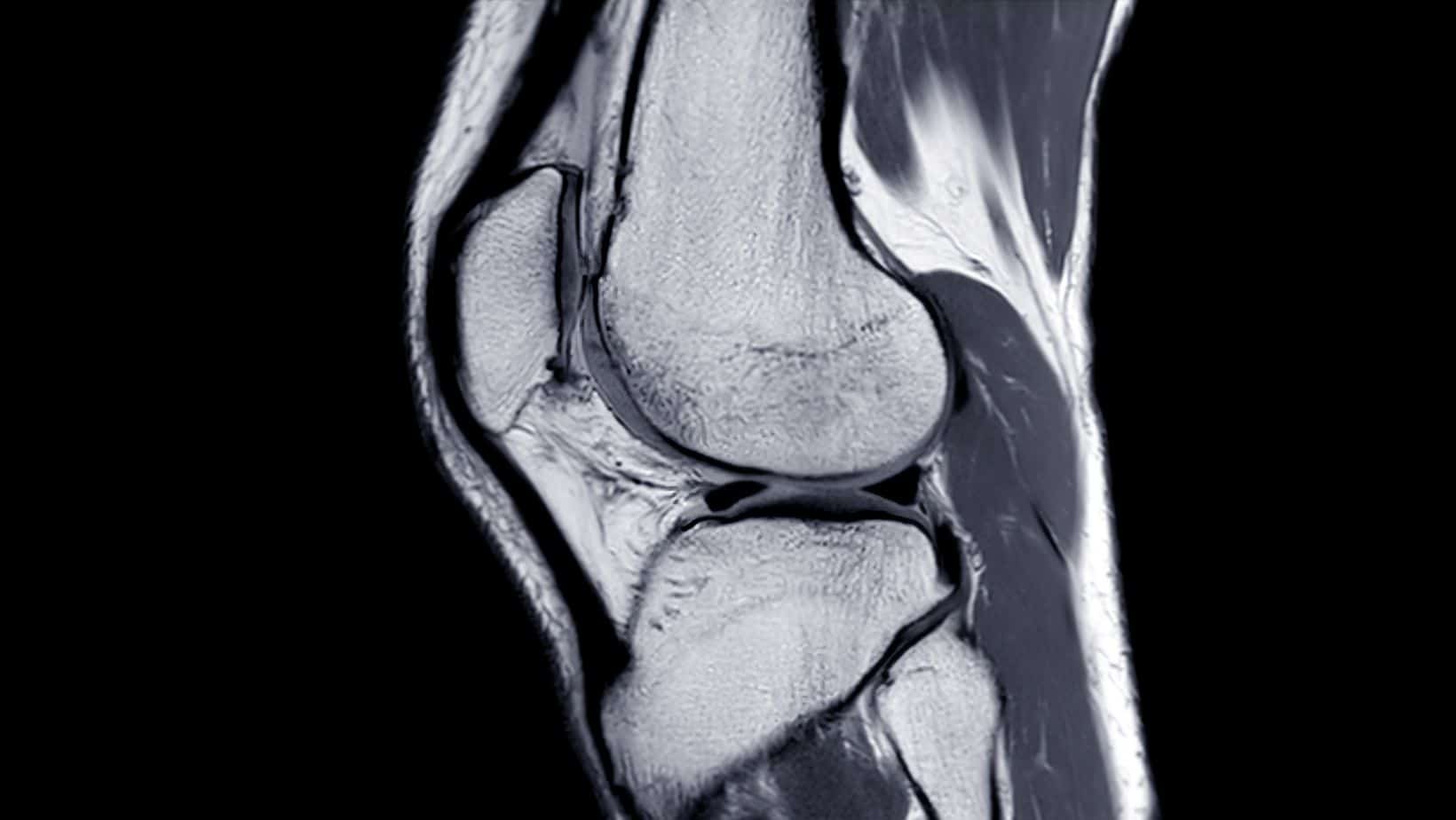 Chondromalacia Patella Chondrosis of the Knee