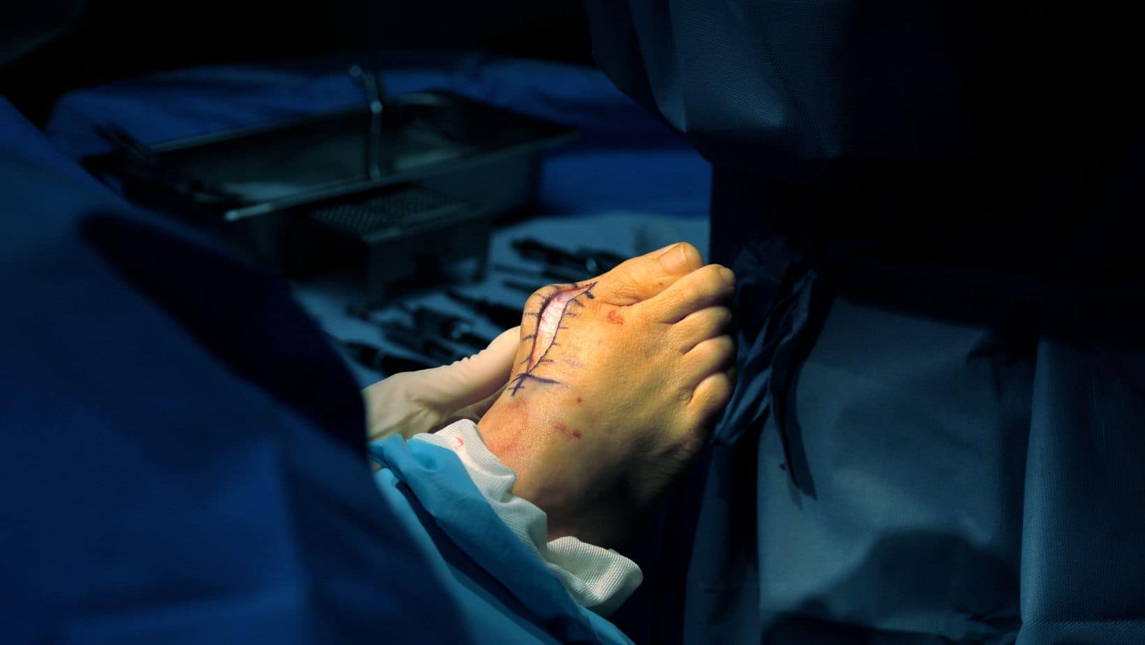 Bunion Questions, Answered! Our Foot Specialist talks, Bunions!