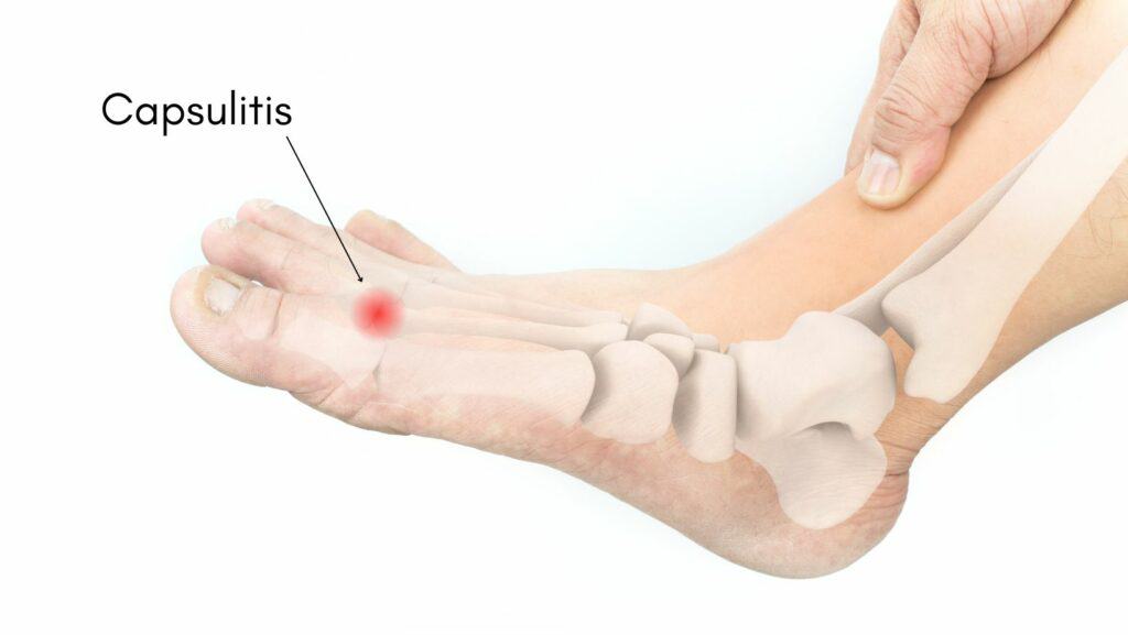 Capsulitis Learn How to Treat Capsulitis from a Foot Specialist