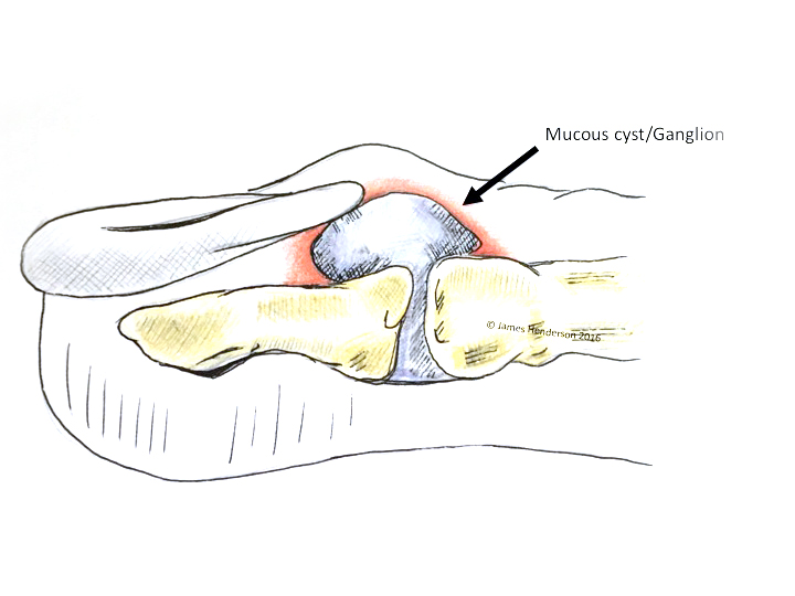 Ganglion Cysts (Ganglia) James Henderson Specialist Plastic & Hand