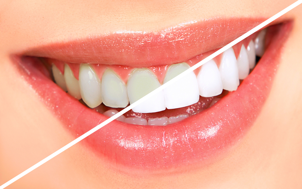 Tooth Stains Intrinsic vs Extrinsic Livonia, MI