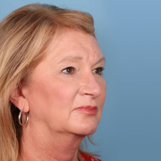 Skin Cancer Reconstruction Dr. James Wang