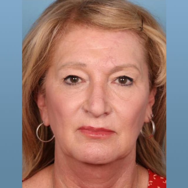 Skin Cancer Reconstruction Dr. James Wang