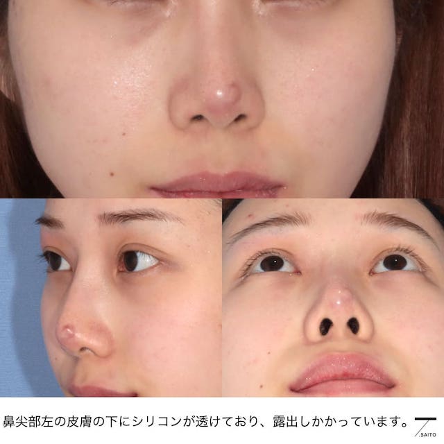 プロテーゼや糸の鼻整形後皮膚トラブルはどう治す？実際の修正手術解説 さいとう（齋藤）隆文 公式HP｜美容外科医