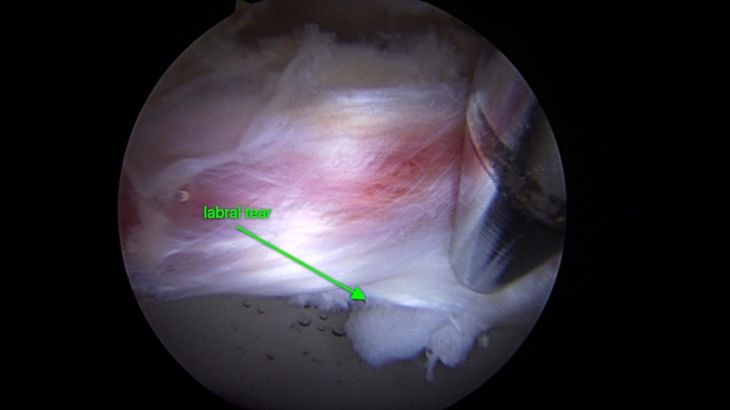 Hip Arthroscopy Jared Lee, MD