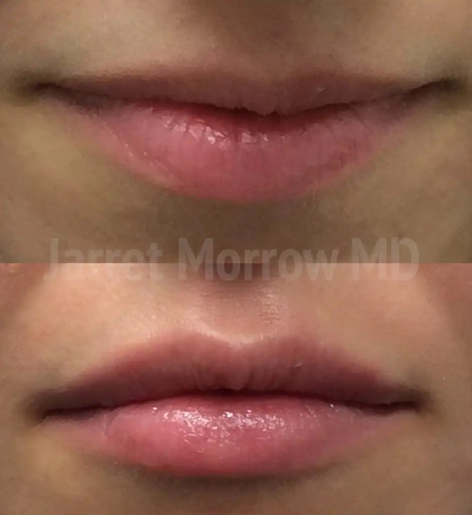 Lip Fillers Geelong Lip Injections & Augmentation Dr Morrow