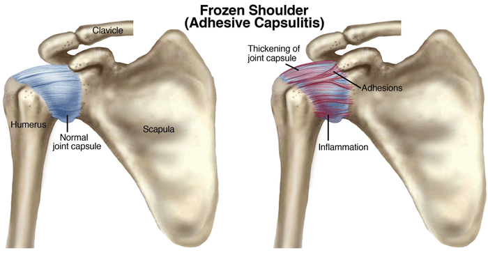 Frozen Shoulder (Adhesive Capsulitis) Alternatives To Surgery Dr