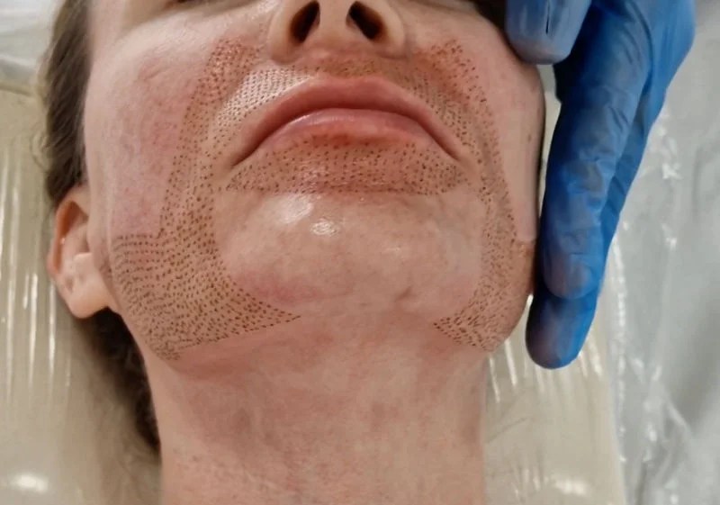 Plasma Pen Treatment High Buckinghamshire