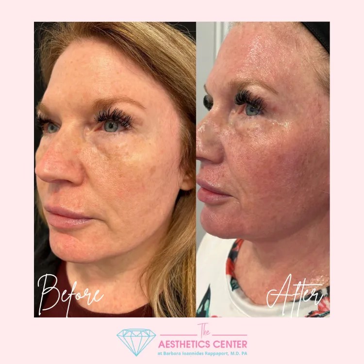 Face and Neck Gallery Jax Aesthetics Center