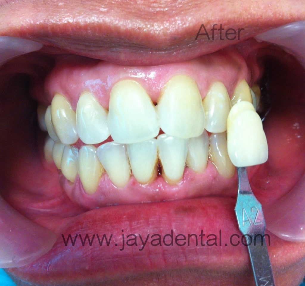 Case 1 (aft tx_shade A2) Jaya Dental Surgery