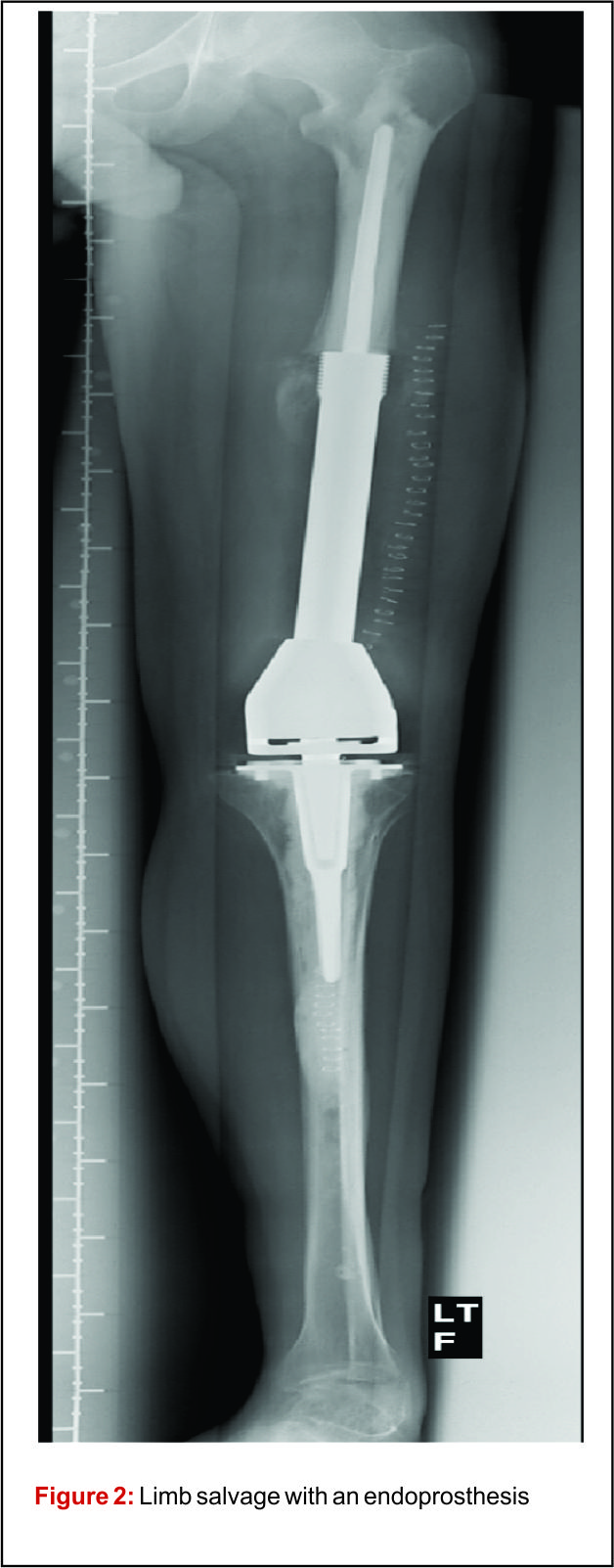 How important are surgical margins in Journal of Bone