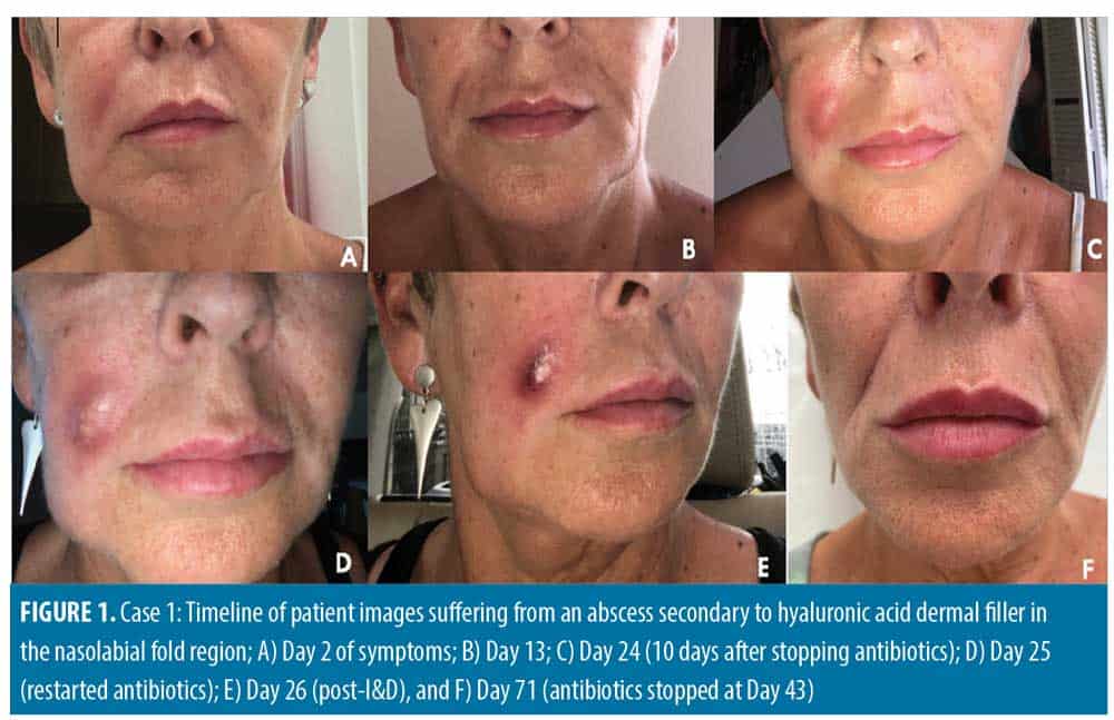 Case Series and Review on Managing Abscesses Secondary to Hyaluronic