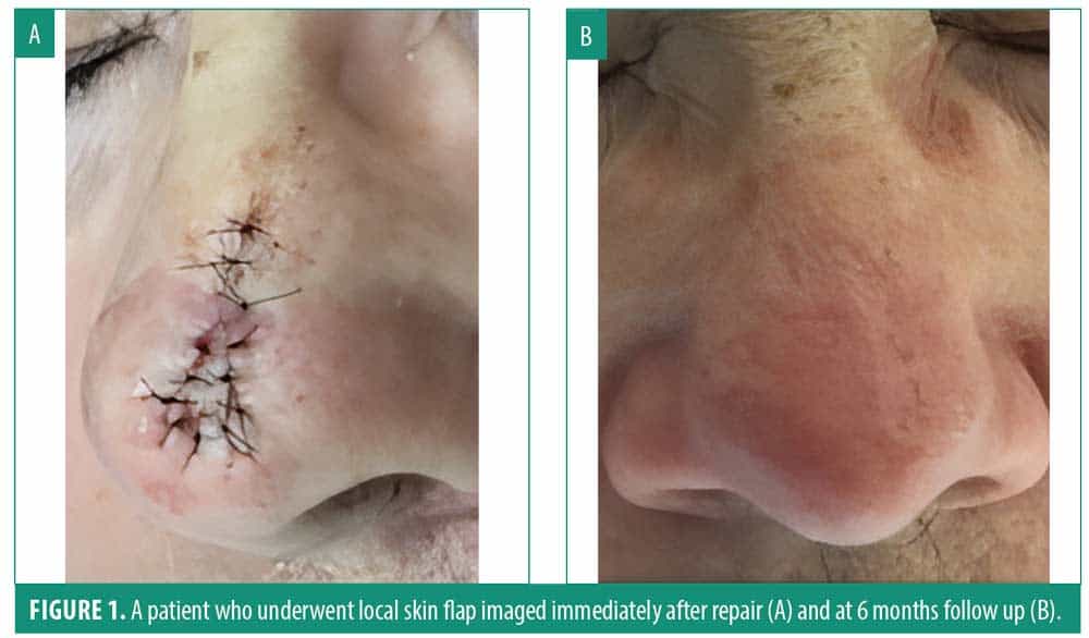 Surgical Following Mohs Micrographic Surgery for Basal Cell
