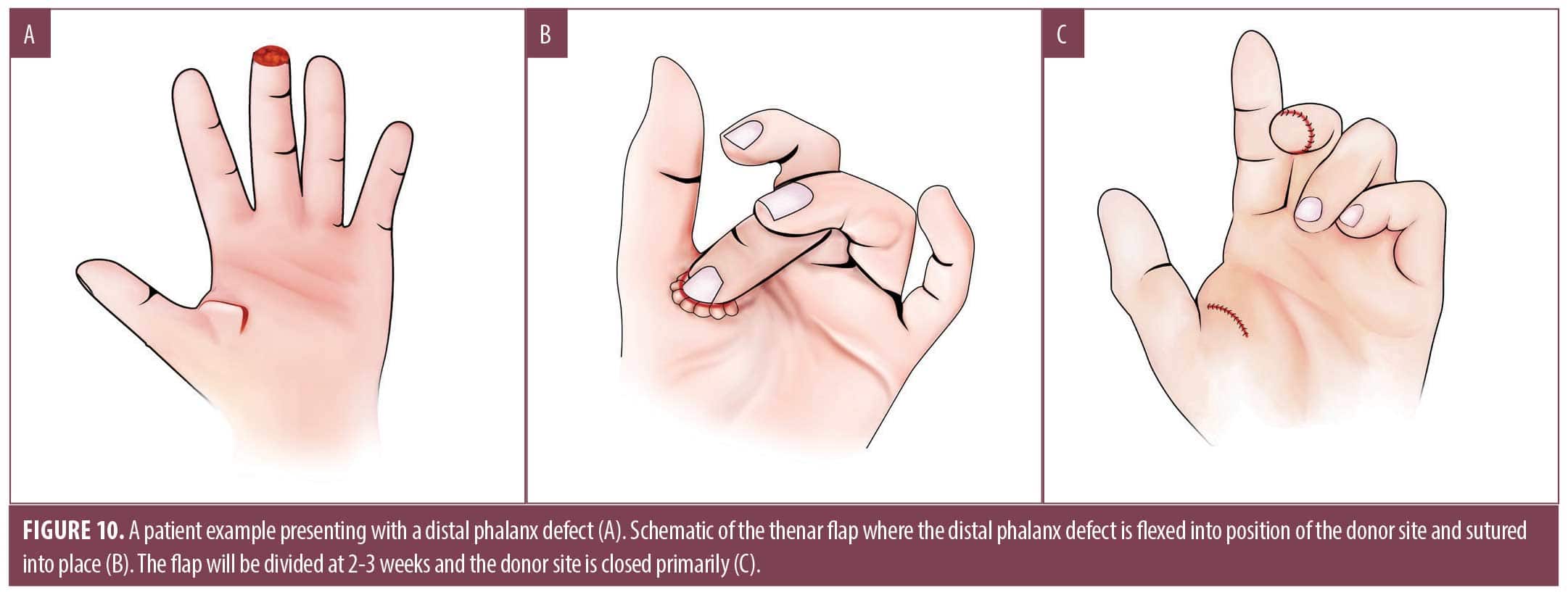 Review of Cutaneous Repairs on the Hand and Fingers Following Dermatologic Surgery JCAD The
